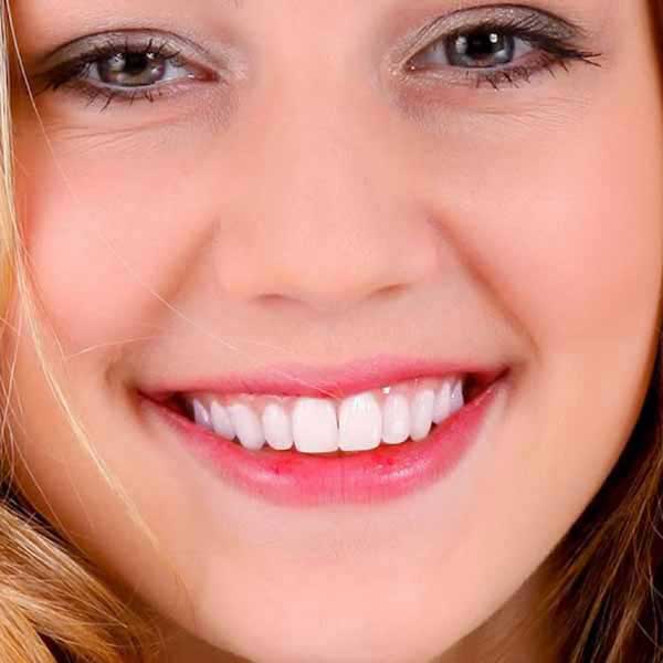 Después del tratamiento dental - resultado exitoso