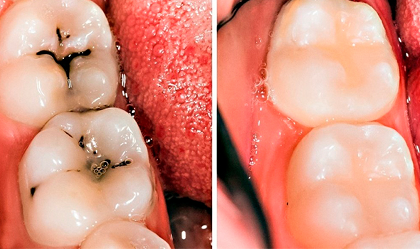 Servicio de curaciones dentales