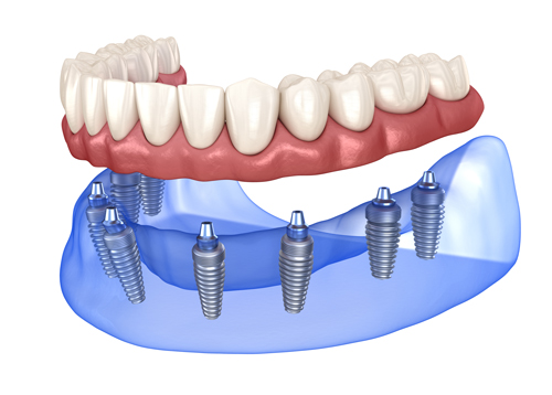 Servicio de prótesis dentales
